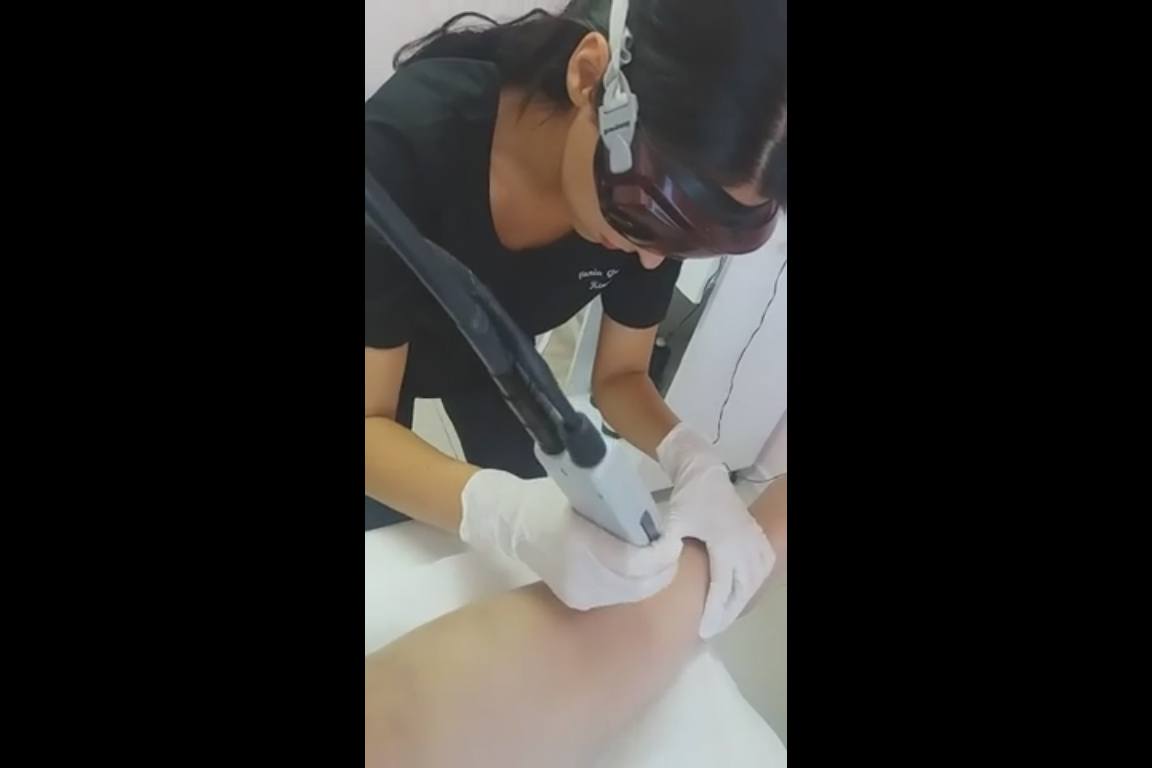 Depilacion Femenina con Laser Alexandrita en Piernas