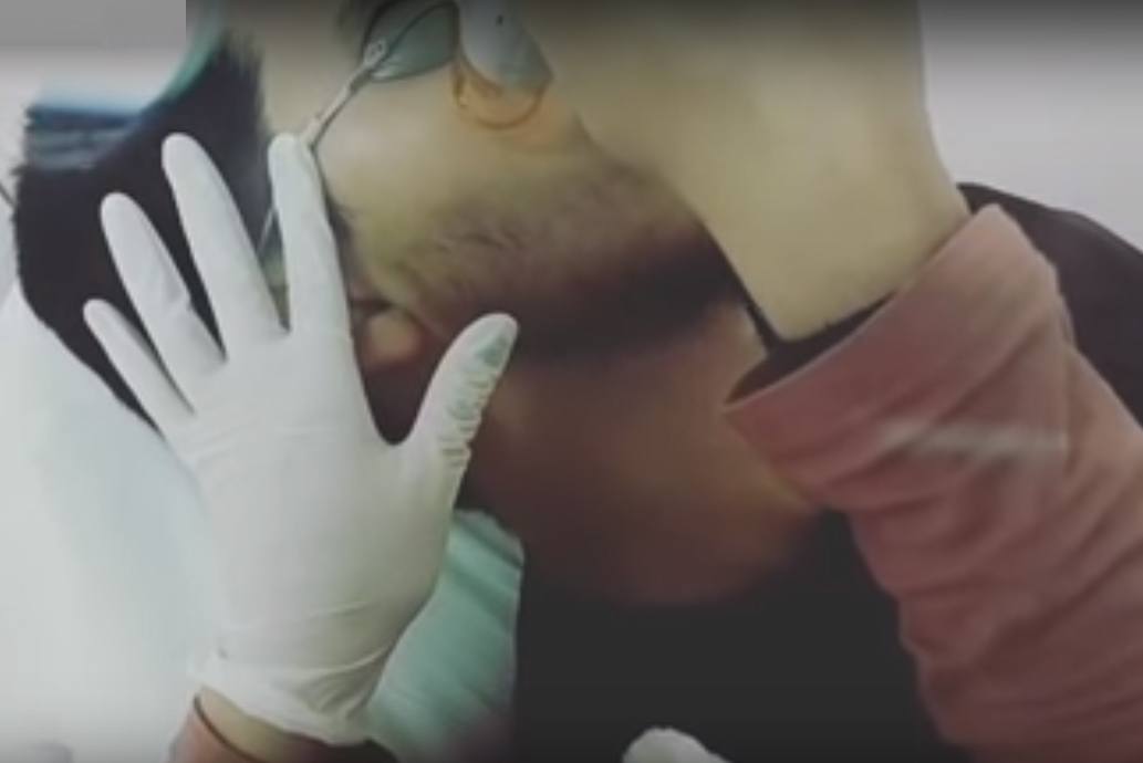 Depilacion Laser Masculina